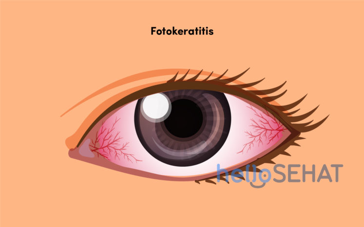 fotokeratitis