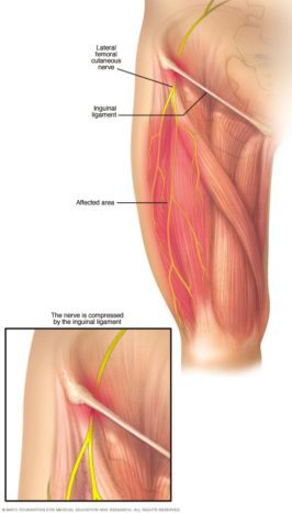 meralgia paraesthetica